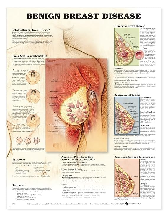 Lake Forest Anatomicals Educational Models Female Benign Breast Disease Chart